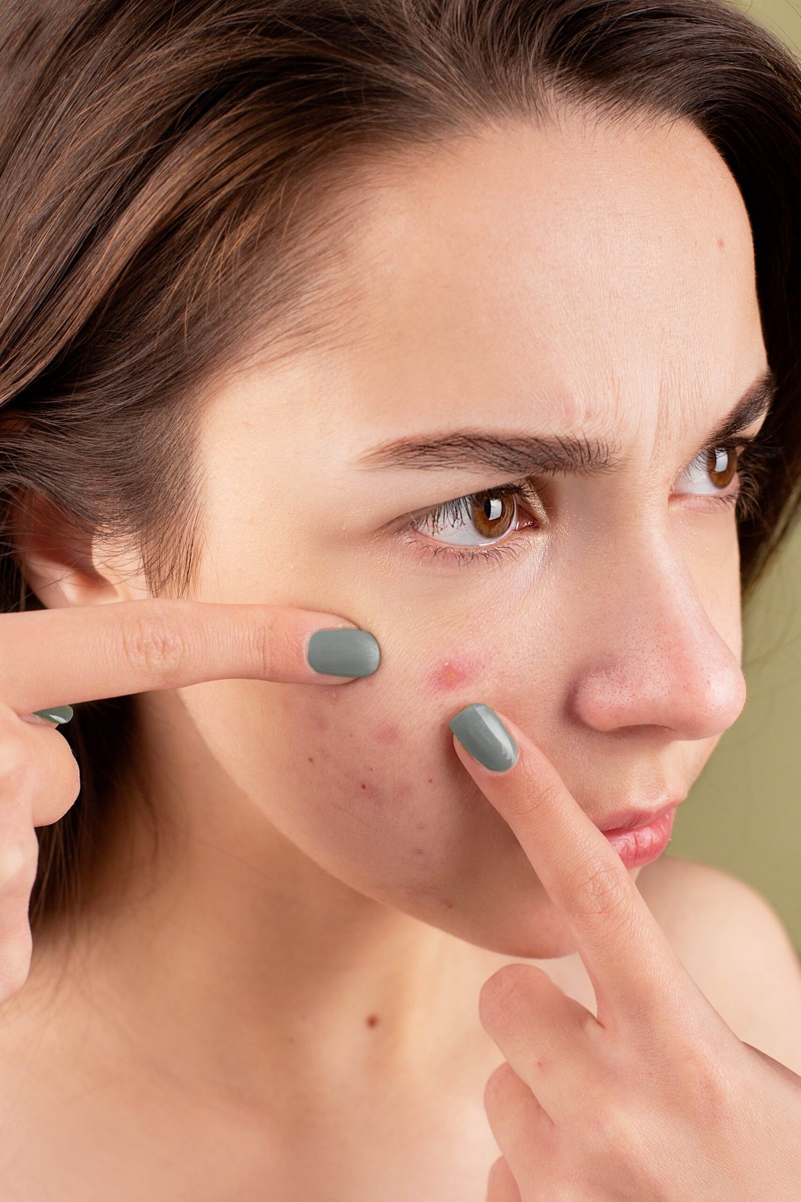 get rid of acne