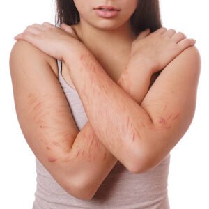 how to get rid of self-harm scars